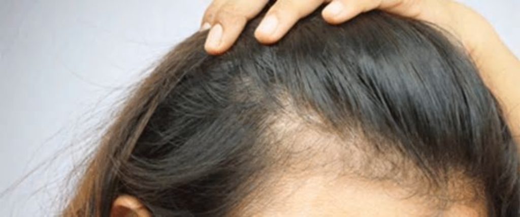 5 ways you are losing hair