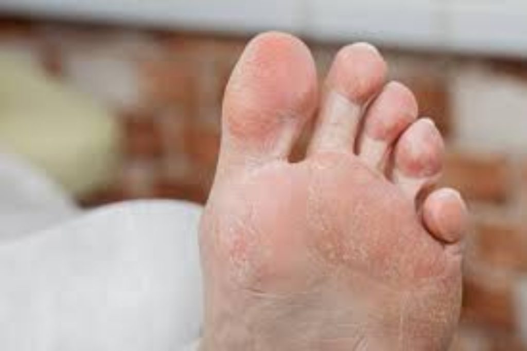 How to take care of cracked feet