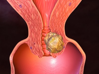 uterine_cancer.jpg uterine_cancer.jpg